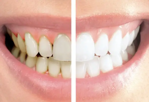 Cómo quitar las manchas de café en los dientes (8 formas)